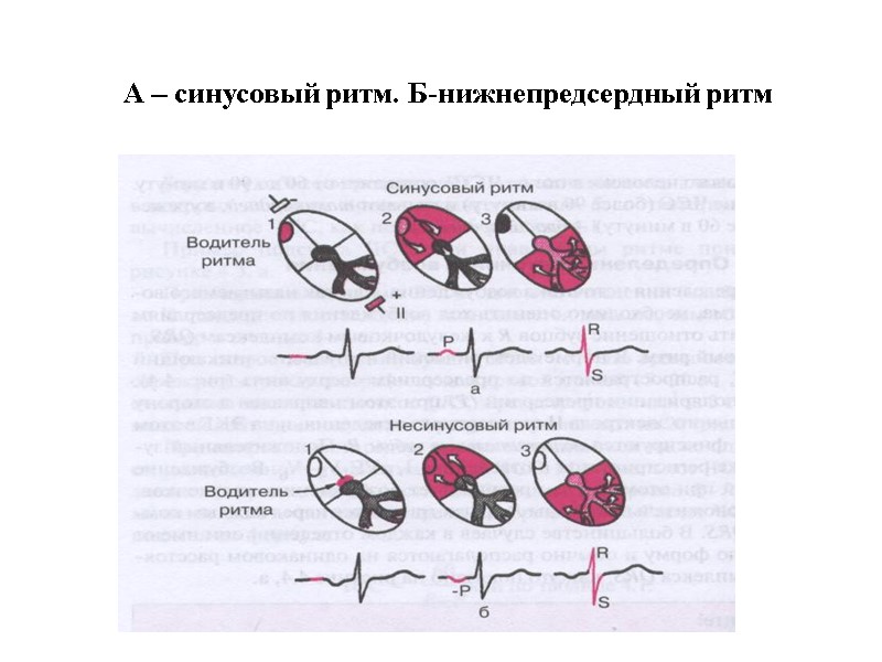 А – синусовый ритм. Б-нижнепредсердный ритм